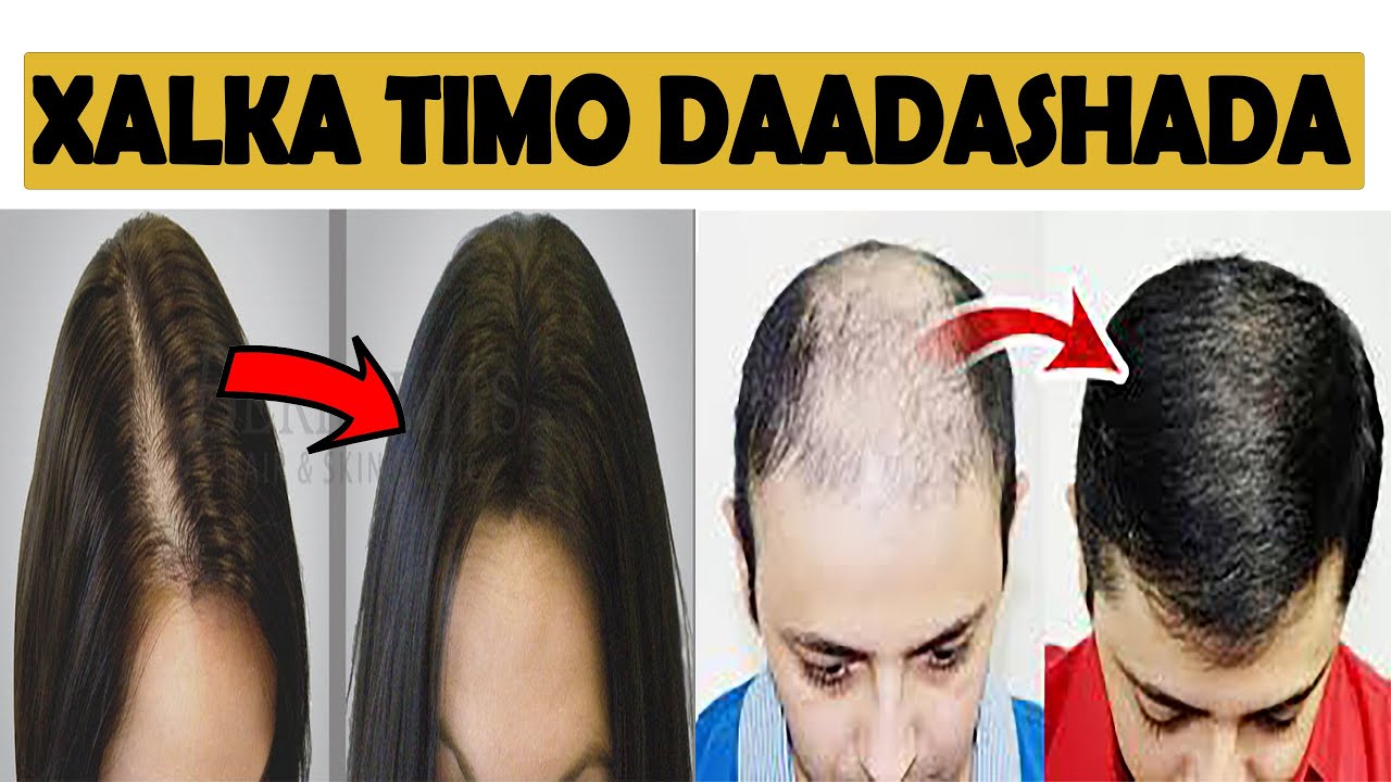 DAWADA TIMO DAADASHADA | XALKA BIDAARTA
