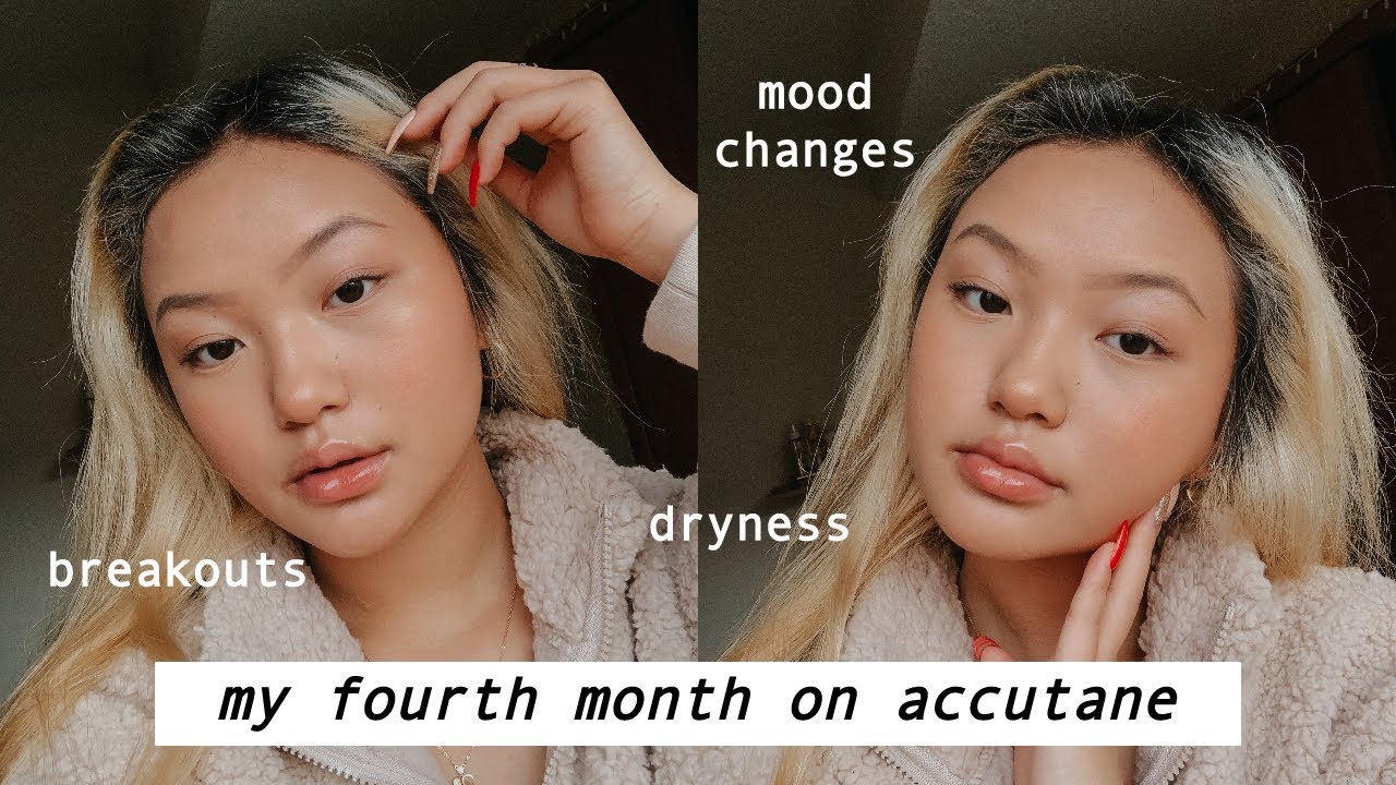 my accutane journey month 4