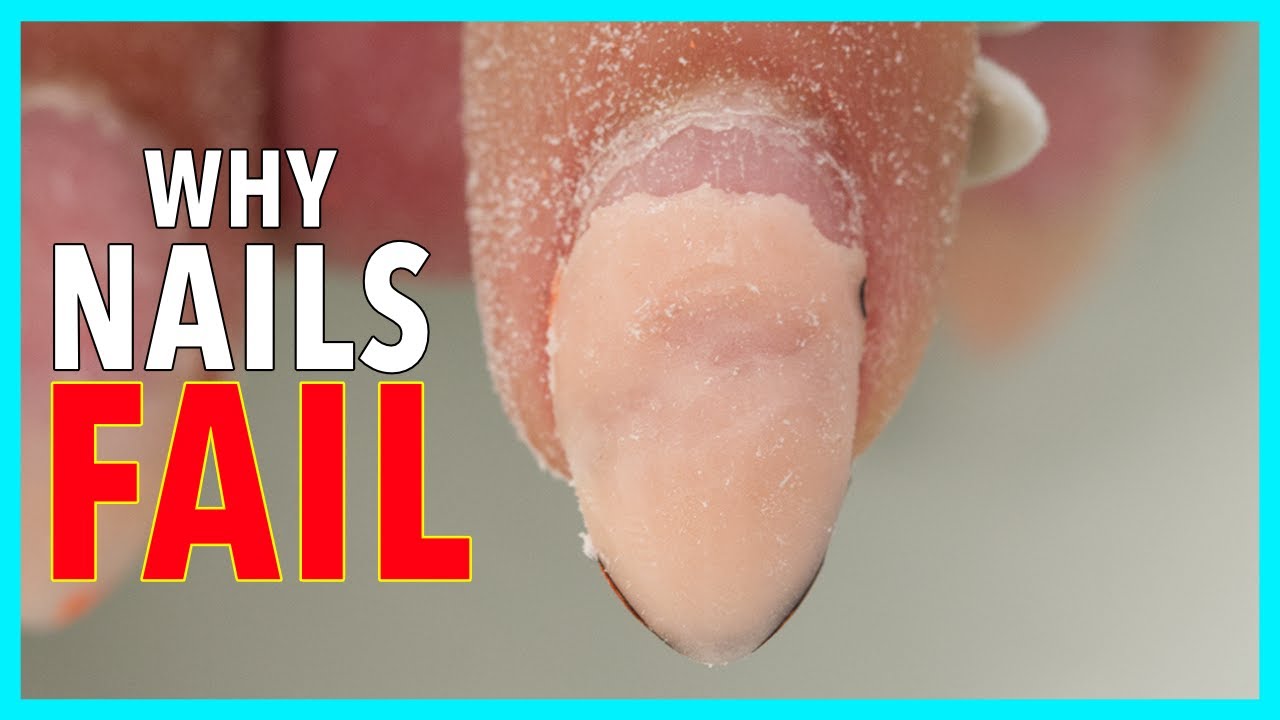 What’s Causing Steve’s Nail Lifting Problem? 🤔