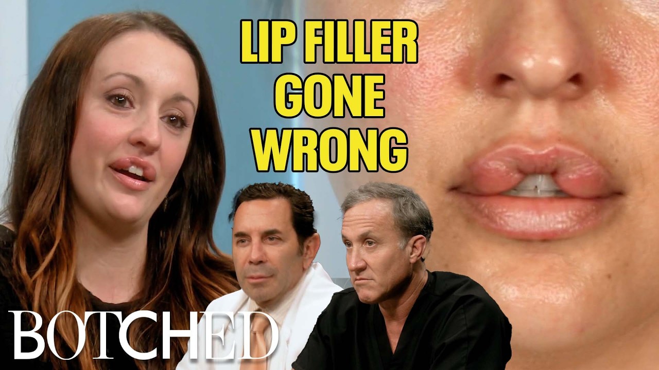 Keara Hasn't Closed Her Mouth in 10 Years After Bad Lip Injections (Before & After) | Botched | E!