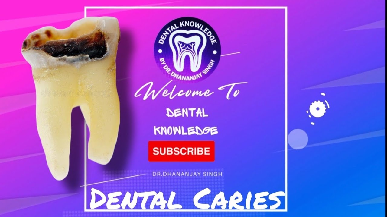 Dental Caries By Dr. Dhananjay Singh