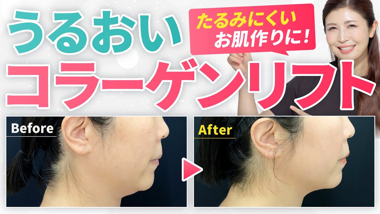 「うるおいコラーゲンリフト」ってなに？たるみは予防できる時代へ、しょうこ先生のイチオシ治療を解説します！【湘南美容クリニック/若返りエキスパートドクター高橋承子】