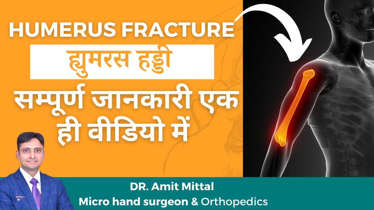 Humerus Fracture in Hindi | Elbow Dislocation Treatment | shoulder fracture | Broken Upper Arm