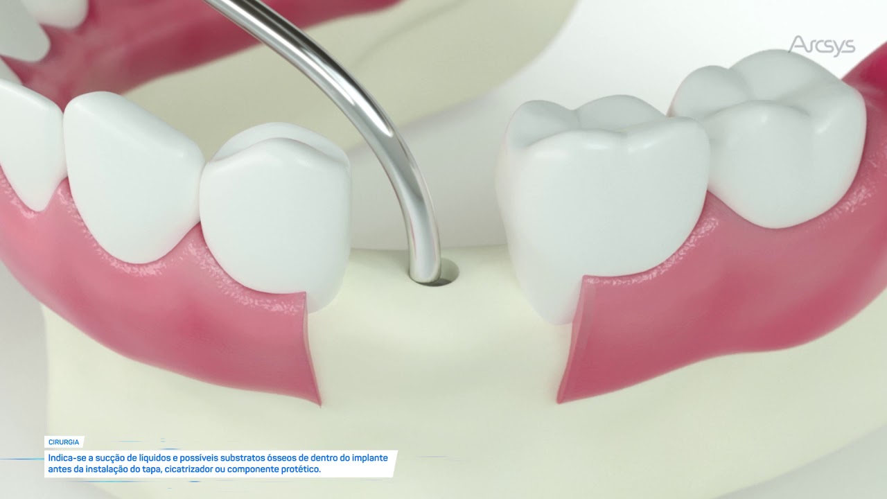 Procedimento cirúrgico e protético - Arcsys Sistema de Implantes | FGM
