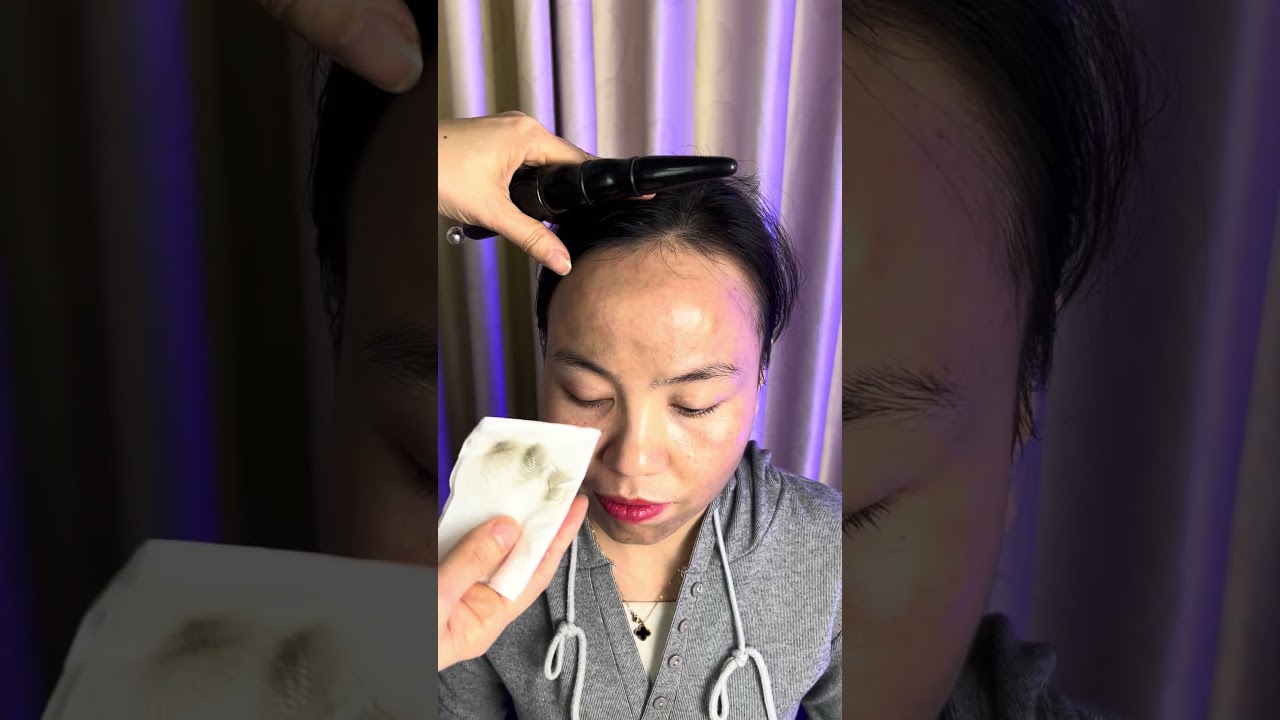 Cạo gió mà đen khắp mặt thì phải làm sao   Cạo gió bạc Bách Chi