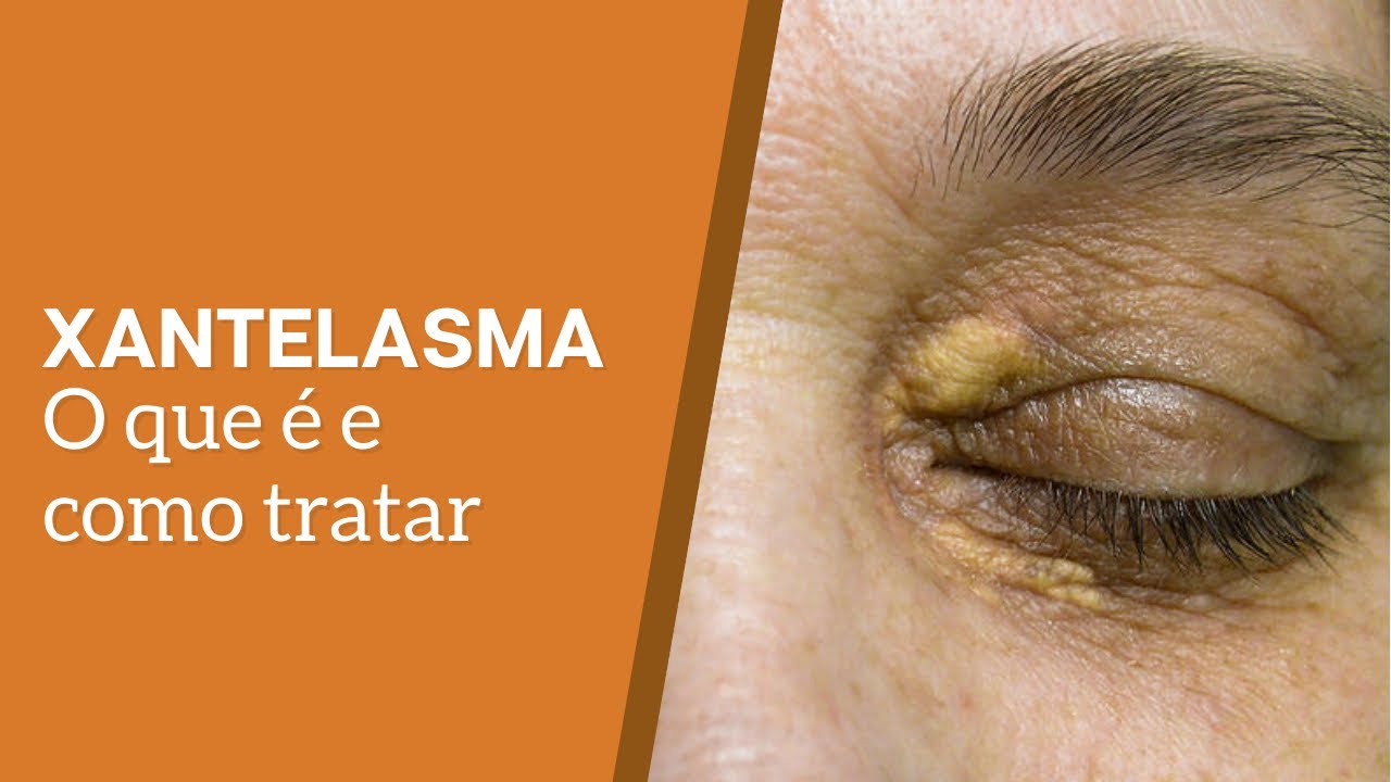 XANTELASMA: O que é e como tratar