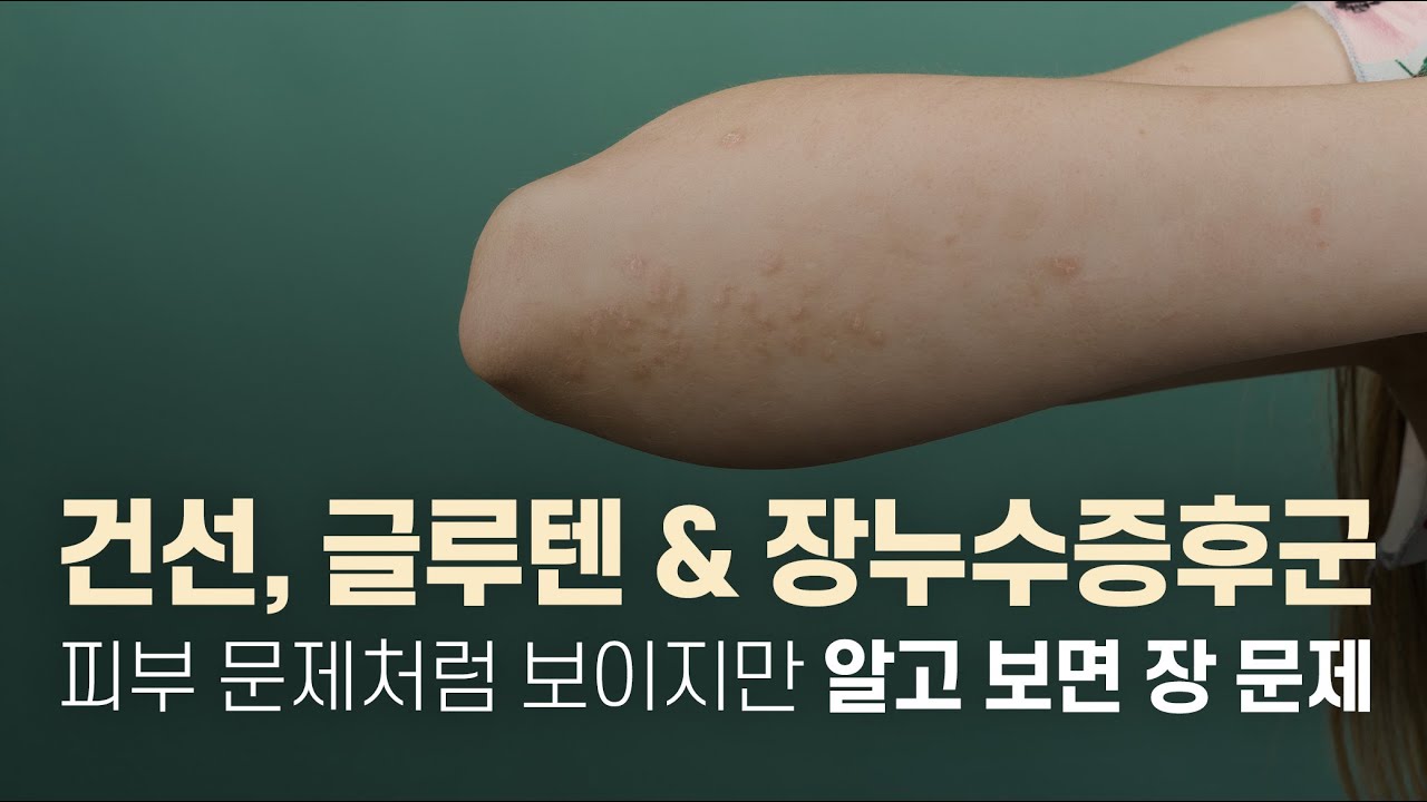 건선은 피부만의 문제가 아니다? 글루텐과 장누수증후군