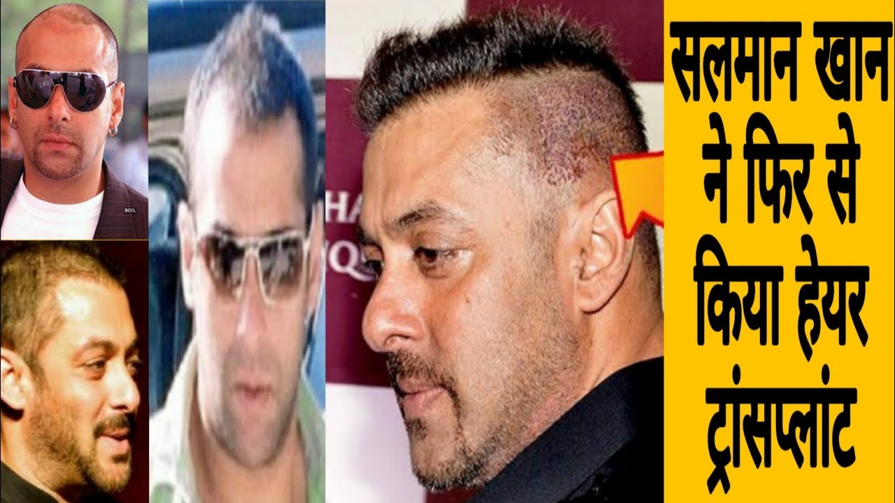 Case Study Salman Khan Hair Transplant Video || Rich Bollywood Celebrity Hair Transplant