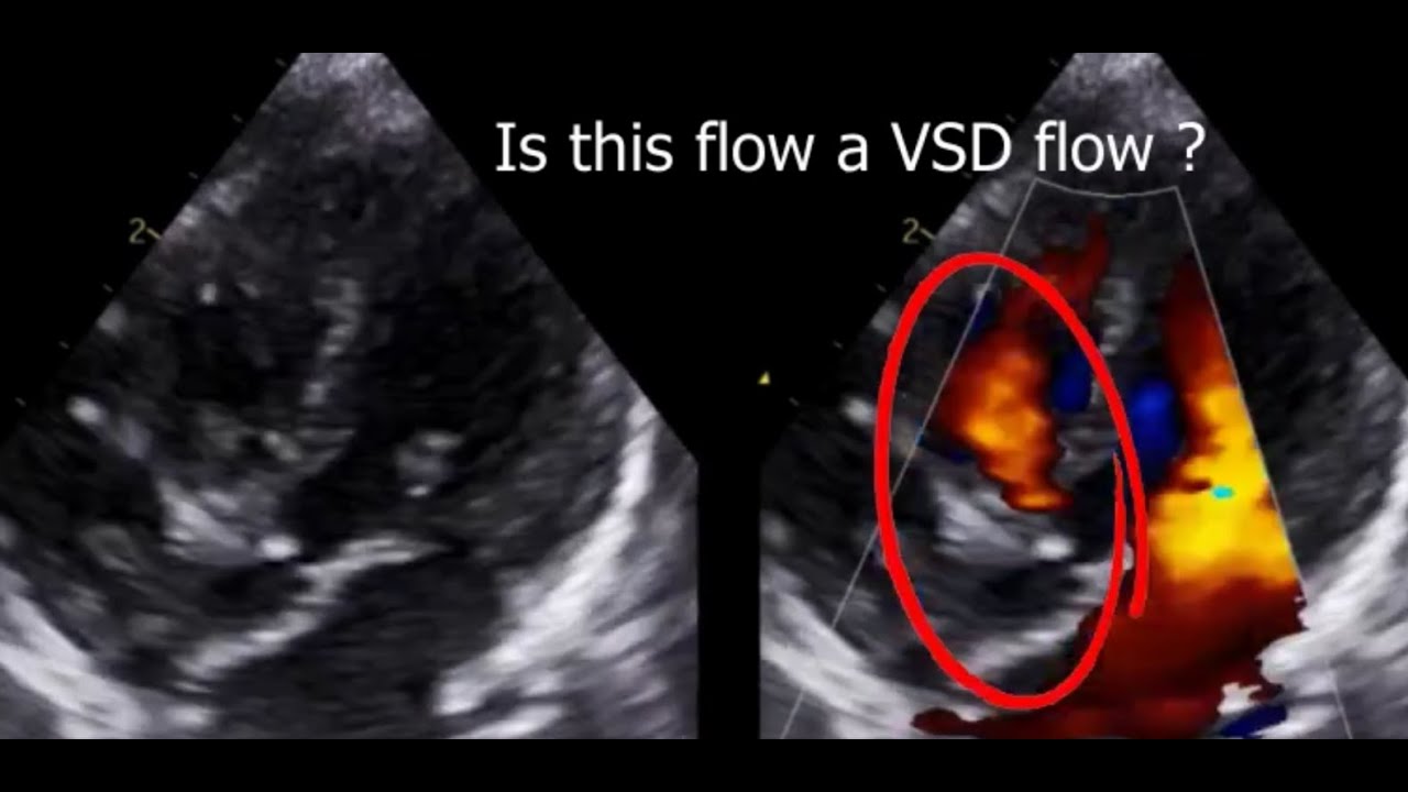 VSD or not❓Don't make this mistake❗
