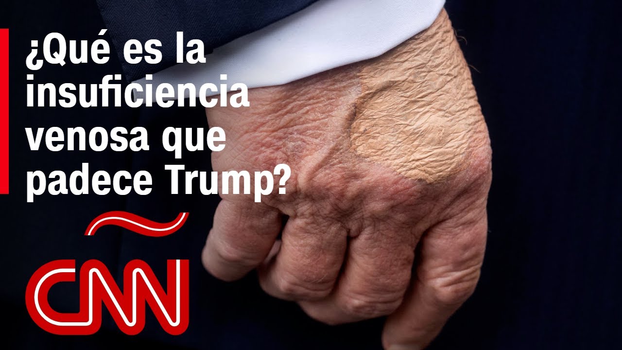 Diagnostican a Trump con insuficiencia venosa cr&oacute;nica. &iquest;Qu&eacute; es esta condici&oacute;n de salud?