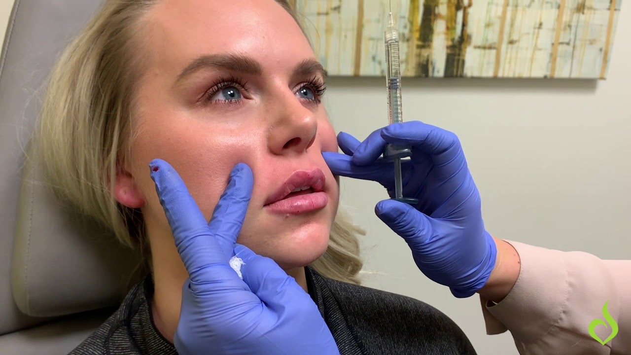 An Inside Look: Lip Filler Consultation