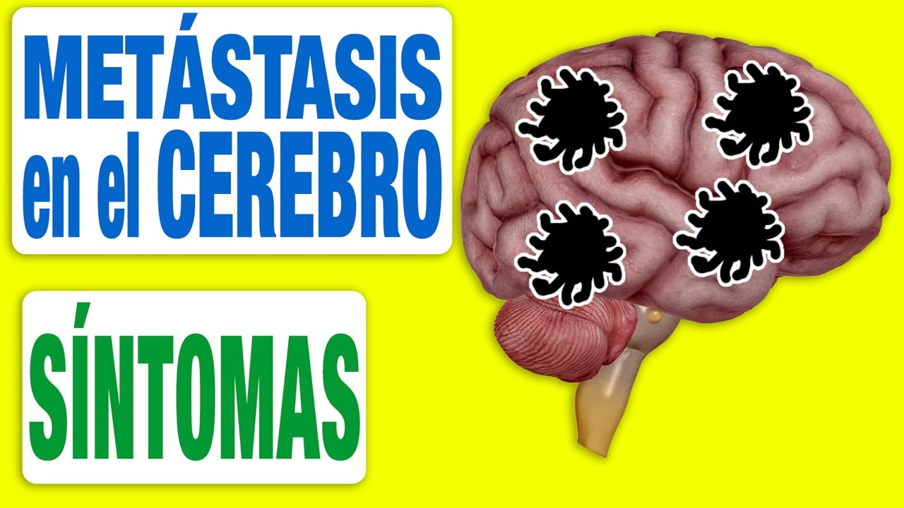 Todos los Síntomas de las Metástasis en el Cerebro
