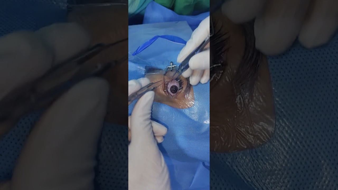 Forced Duction test ( Tight medial rectus muscle)