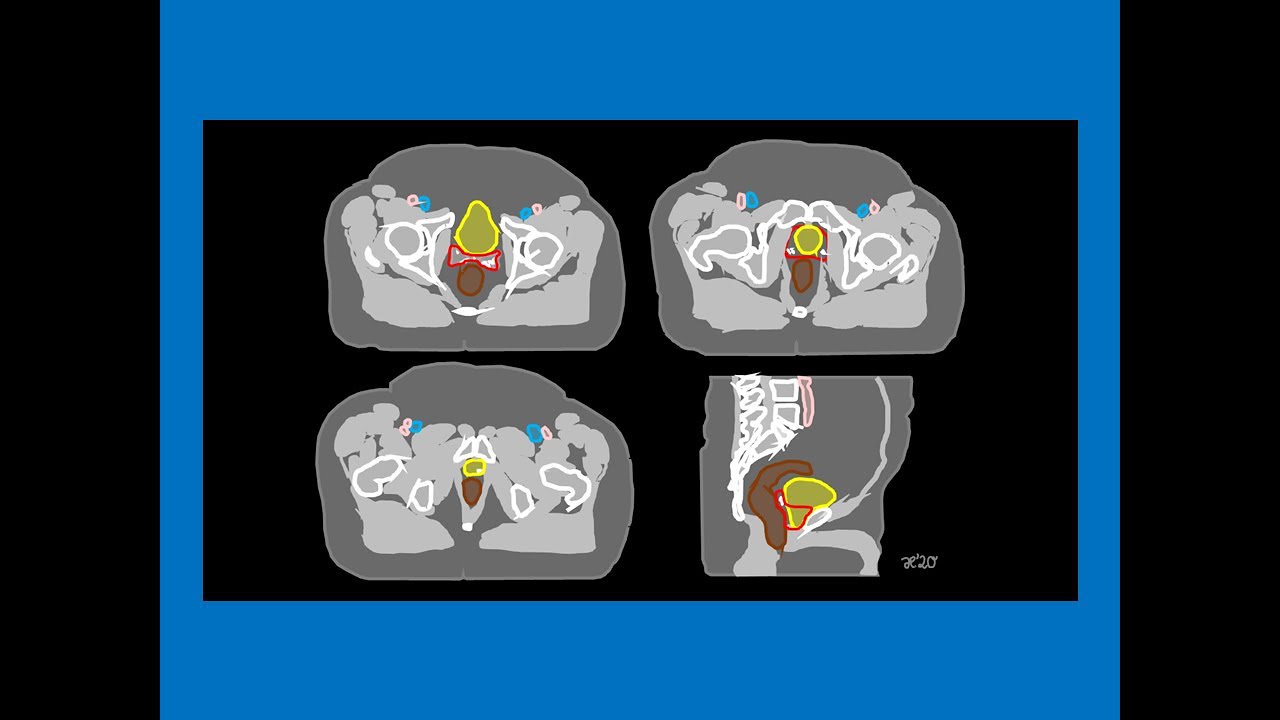 Zielvolumen der Prostataloge | Strahlentherapie Prof. Hilke Vorwerk