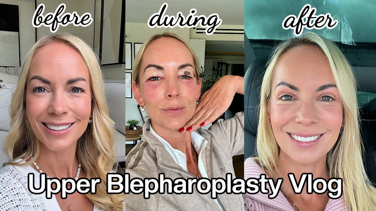 Why I Had Eye Surgery | My Upper Blepharoplasty Journey (Day 1–7 Before & After)