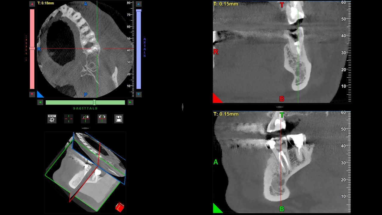 Determining Hounsfield Units from 2D Orthopantogramic X-Rays - A Test