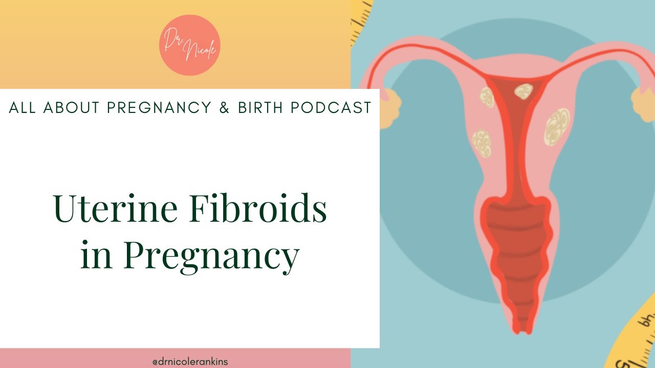 Ep 103: Uterine Fibroids in Pregnancy
