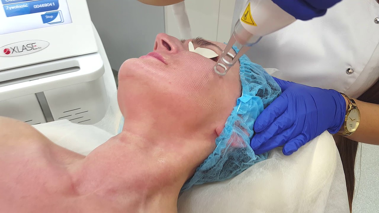 LASEROTERAPIA FRAKCJA urzadzeniem Xlase Plus Marki Biotec Italia. Zabieg na twarz i ciało