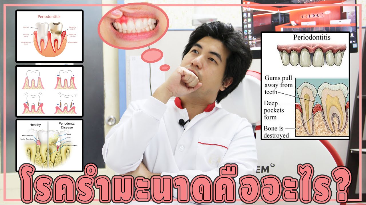 โรครำมะนาดโคตรน่ากลัว !!! ใครไม่อยากเหงือกร่นรีบดูด่วน !