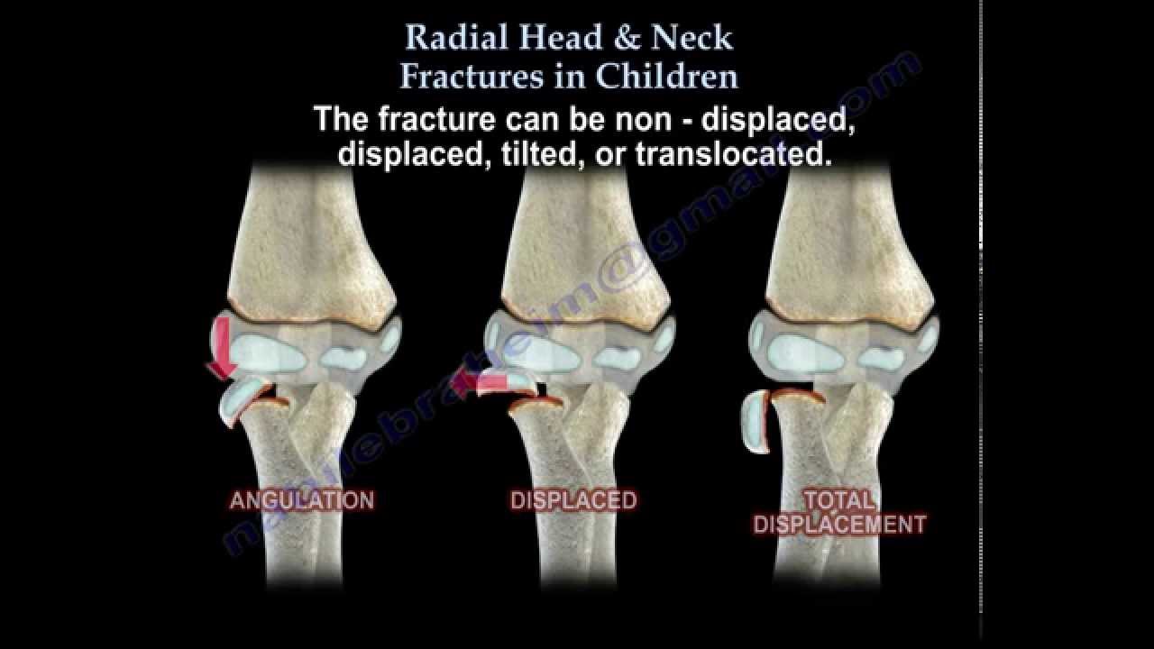 Radial Head & Neck Fractures In Children - Everything You Need To Know - Dr. Nabil Ebraheim