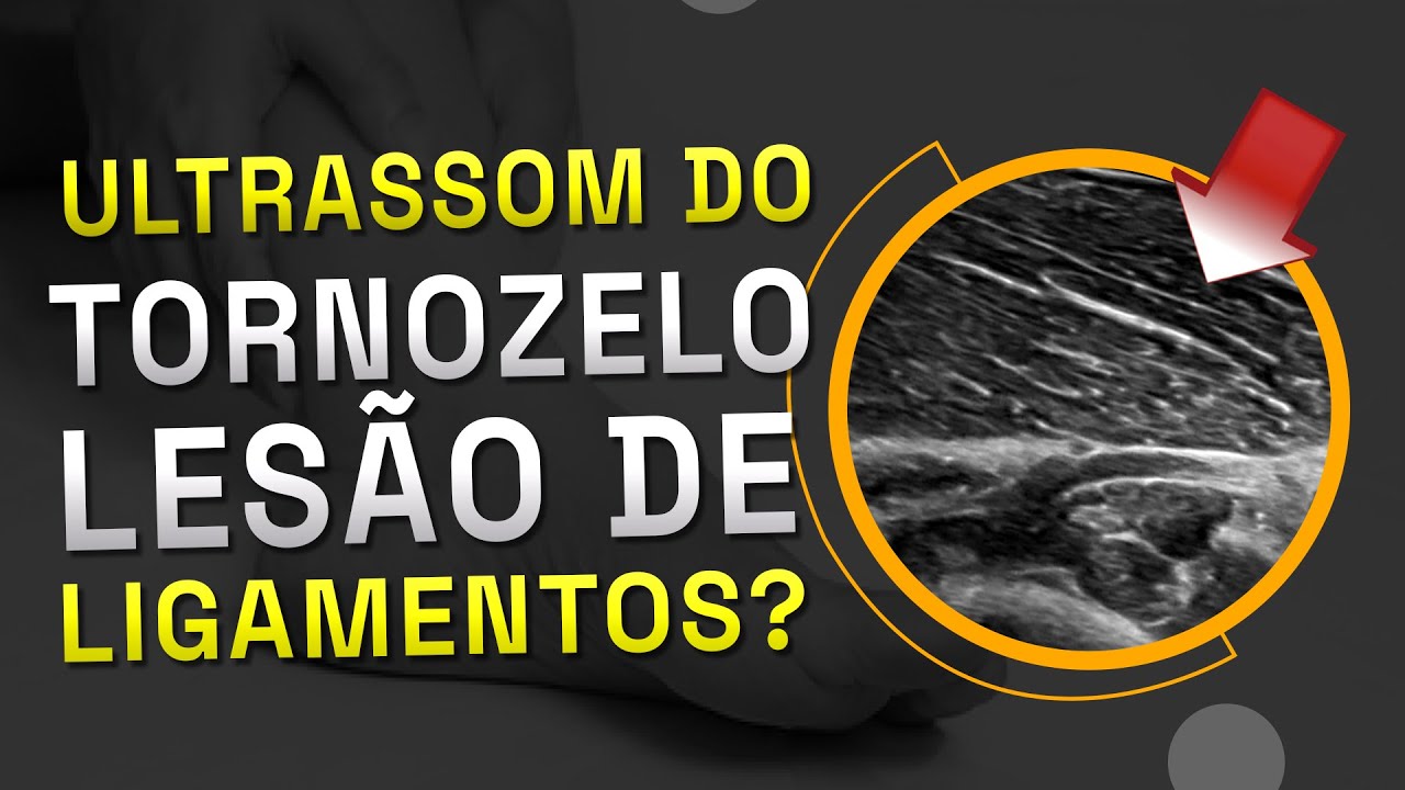 Ultrassom do Tornozelo - lesão de ligamentos?
