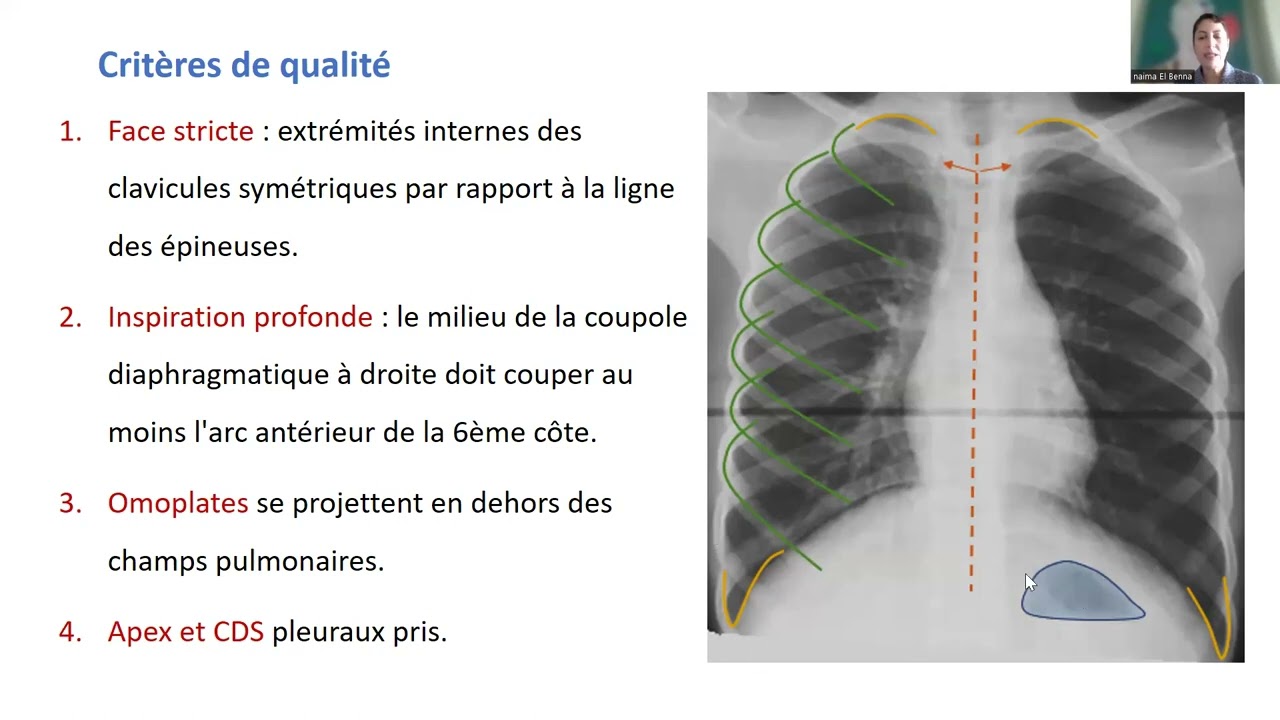 Radiographie thoracique
