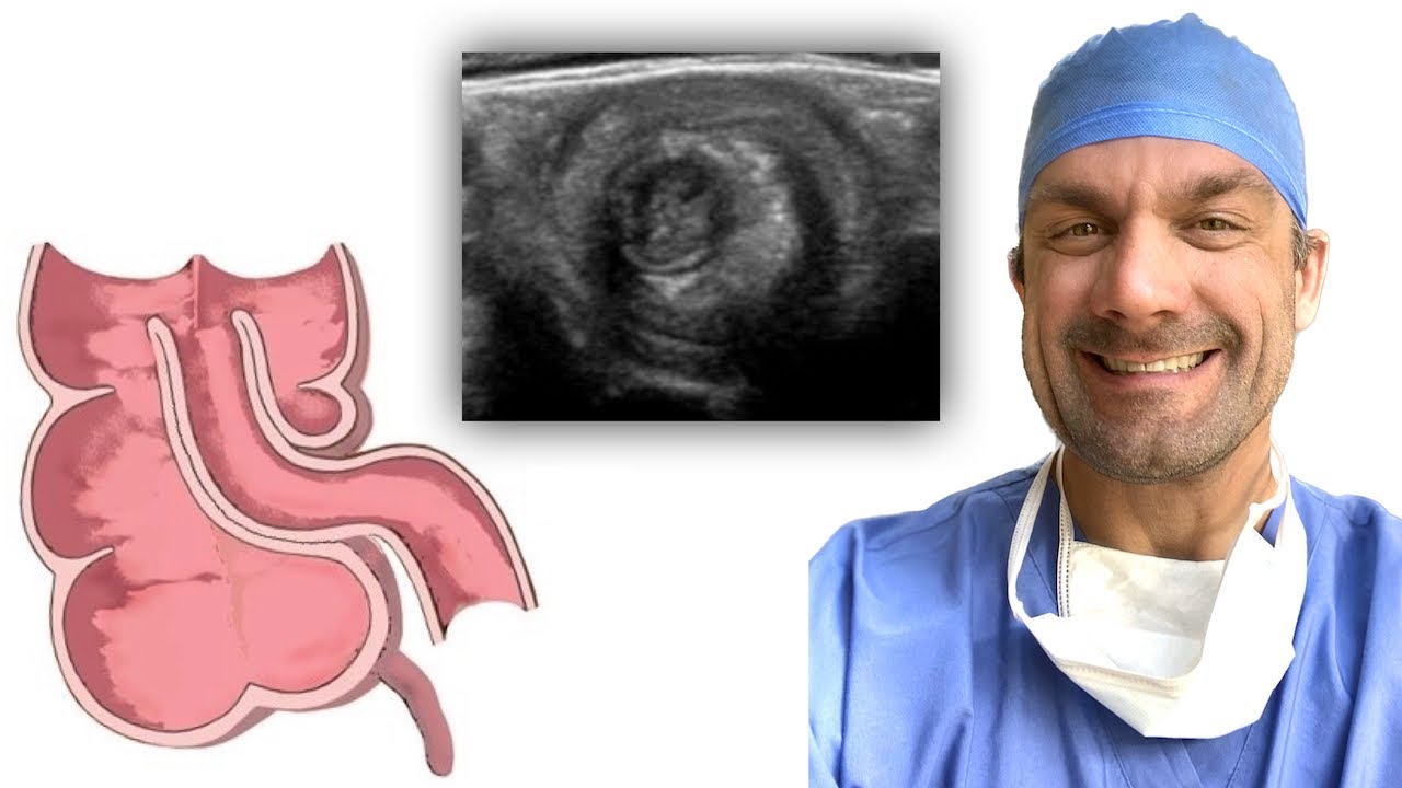 Diagnostic TRICKS for Intussusception