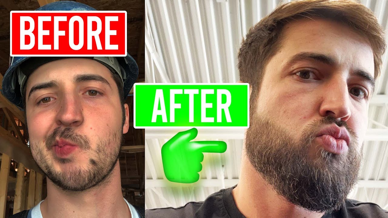 Ultimate Beard Growth Guide: Minoxidil & Micro-Needling