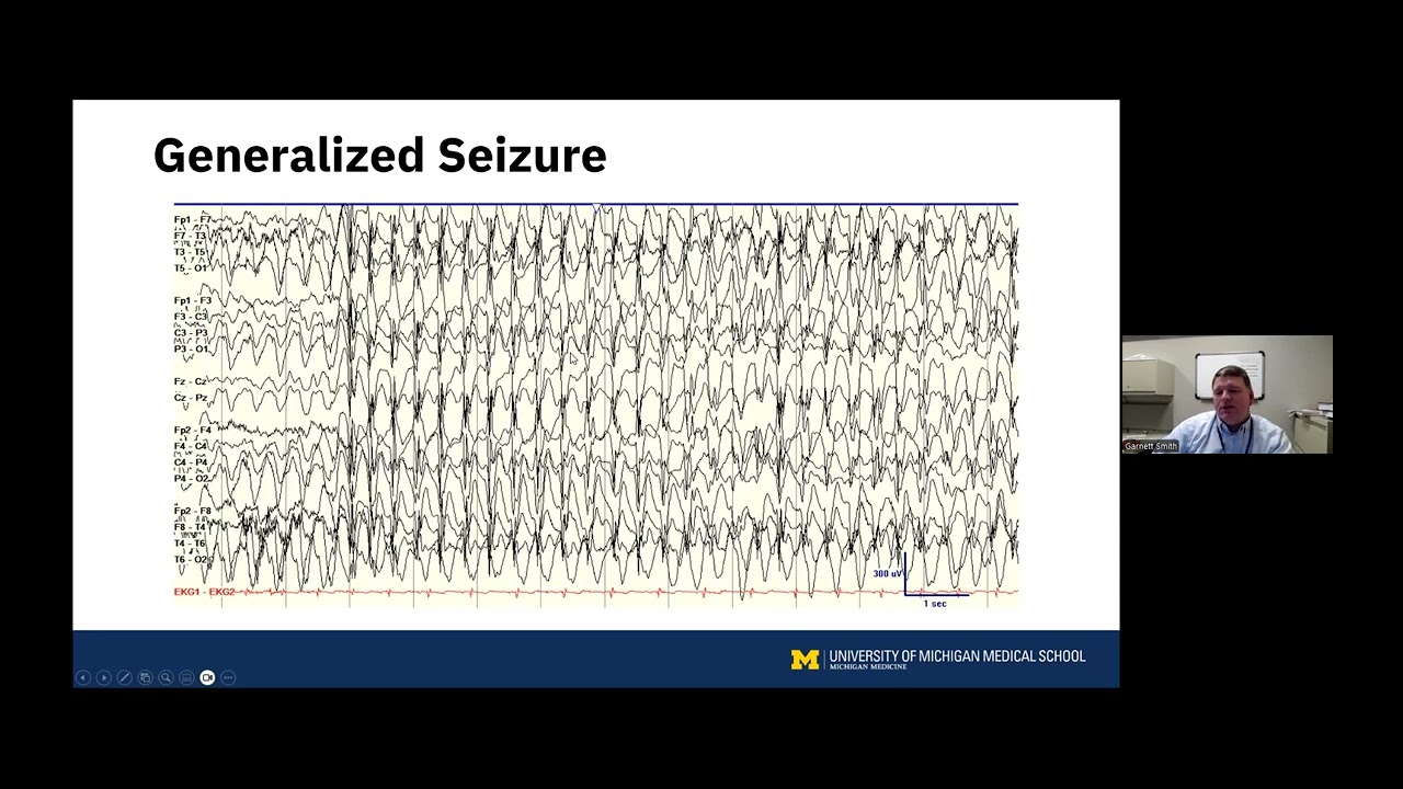 Neuromodulation for Epilepsy