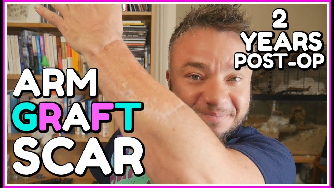 Arm Scar Progress at 2 Years Post Op (FTM Phallo)