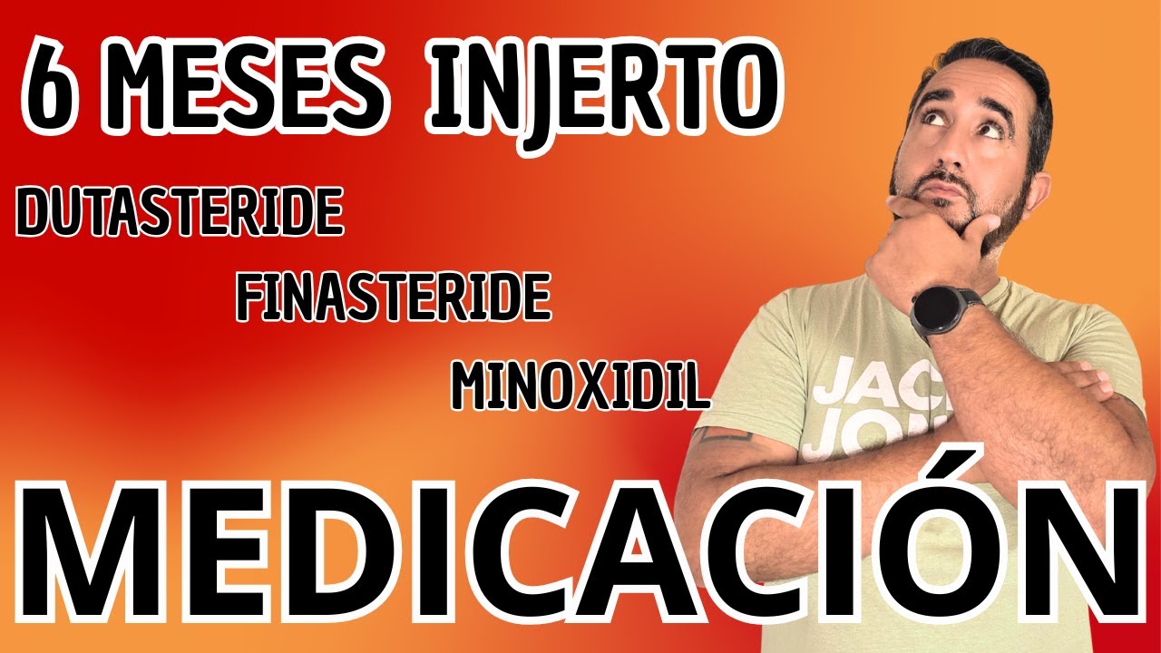 Minoxidil, Finasteride o Dutasteride: ¿qué tomar tras un injerto capilar?