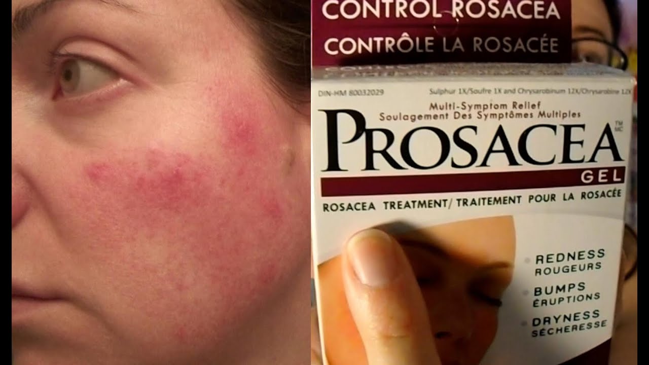 Prosacea Rosacea Treatment Product Review (not sponsored) | Rosy JulieBC