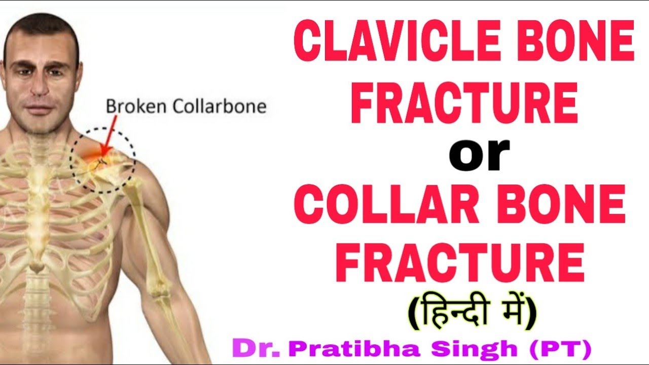 Clavicle bone fracture treatment | Collar bone broken treatment in Hindi | Dr. Pratibha Singh (PT)