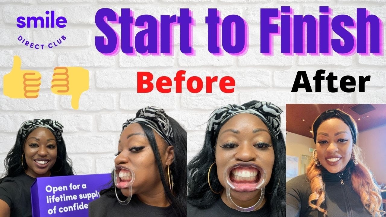 Smile Direct Club Invisible Braces Journey Start to Finish! I Smile Direct Club Review