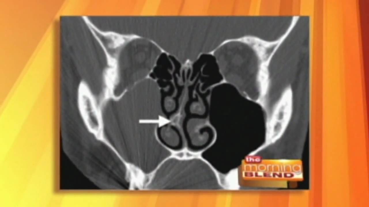 Nasal Triggers for Headaches with Dr. Madan Kandula