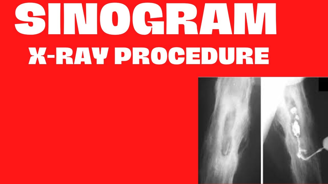 X-ray Procedure Sinogram|Sinogram X-ray Procedure Test in Radiology|In Urdu| Hindi @Easy Radiography