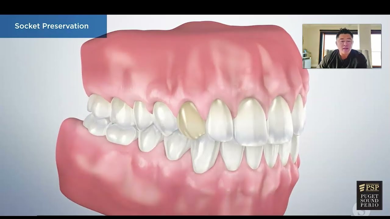 Tooth Removal and Bone Grafting Procedure.  Understanding your procedure and what happens next.