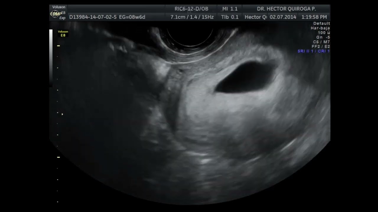 Embarazo de 8 semanas  Malformación Mulleriana  Utero Bicorne vs Utero Septado.