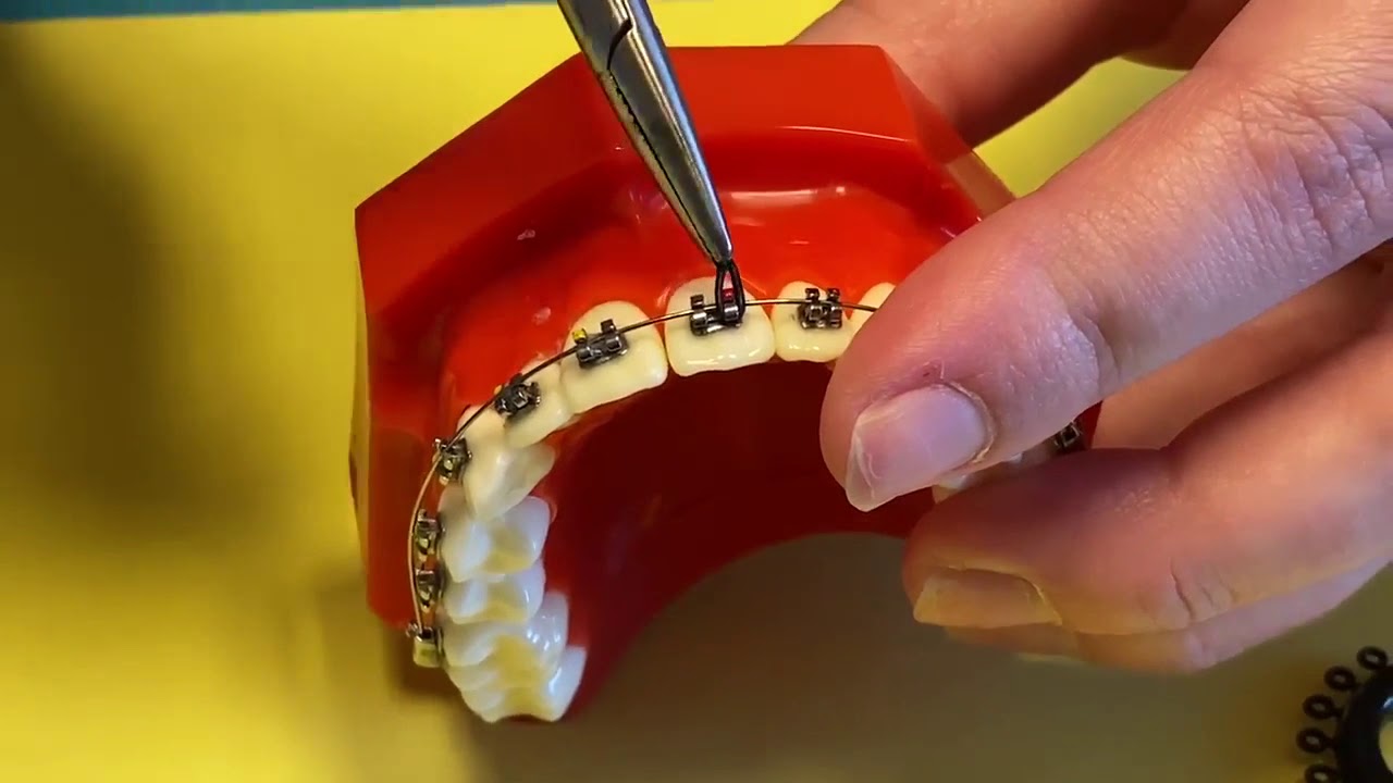 Replacing an O-Tie (Small Rubber Band) on your Braces