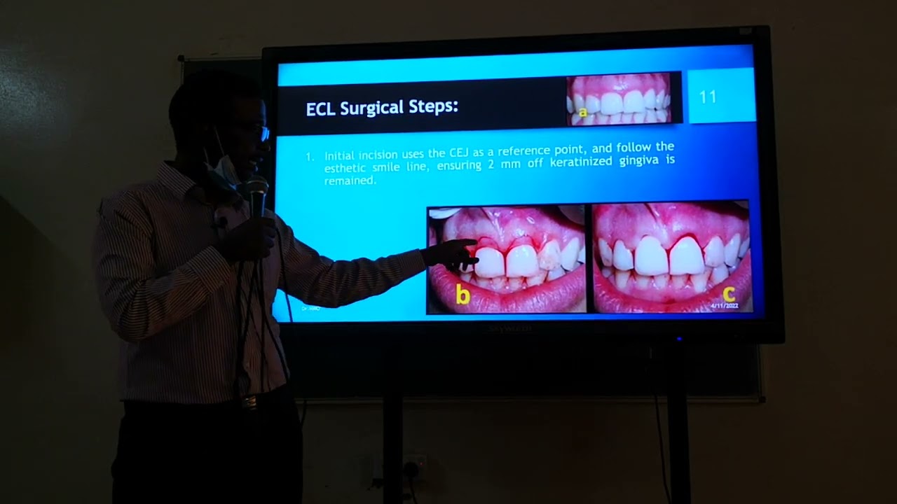 شرح مادة علاج اللثة للدكتور مصعب - Crown Lengthening