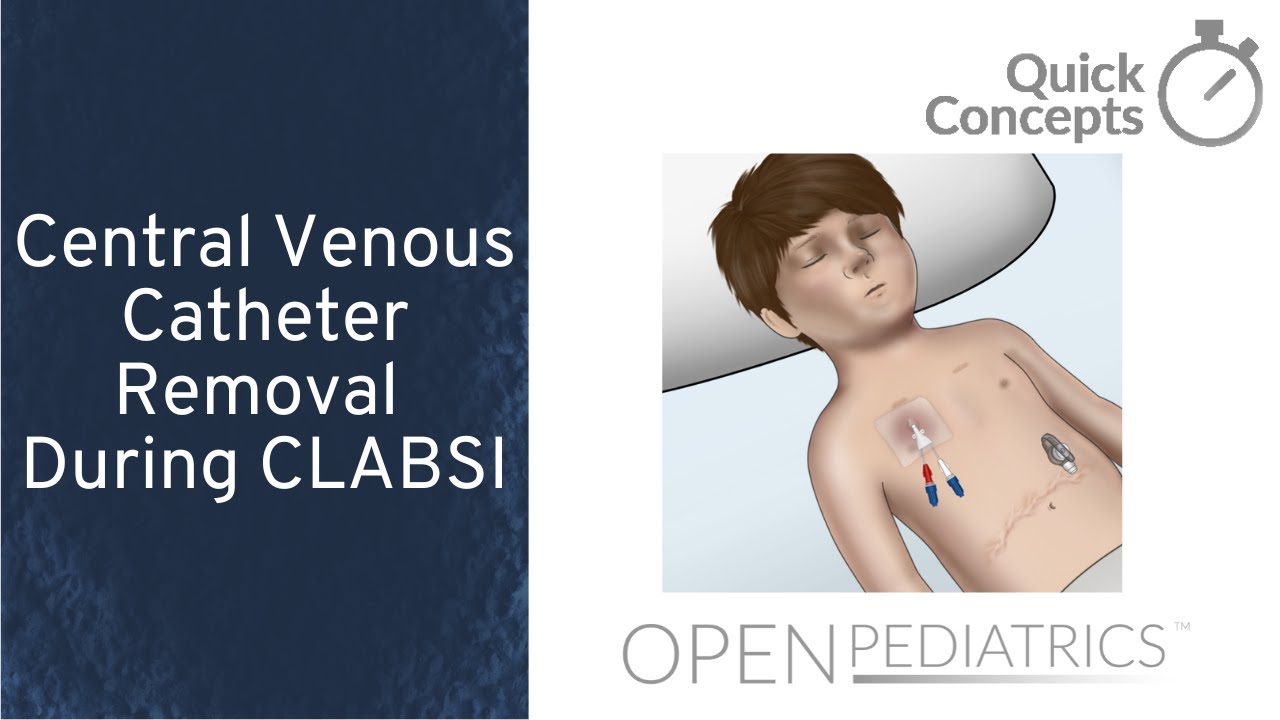 Central Venous Catheter Removal During CLABSI by N. Gluchowski et al. | OPENPediatrics