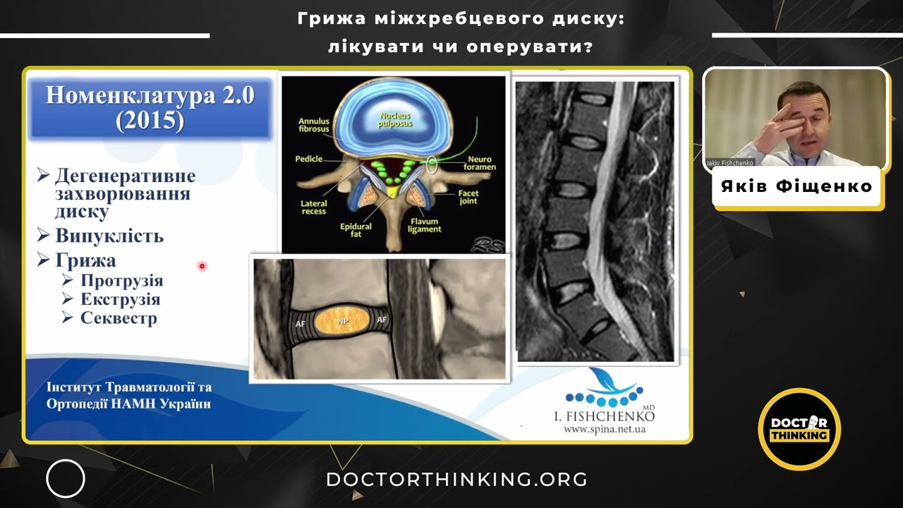 Грижа міжхребцевого диску