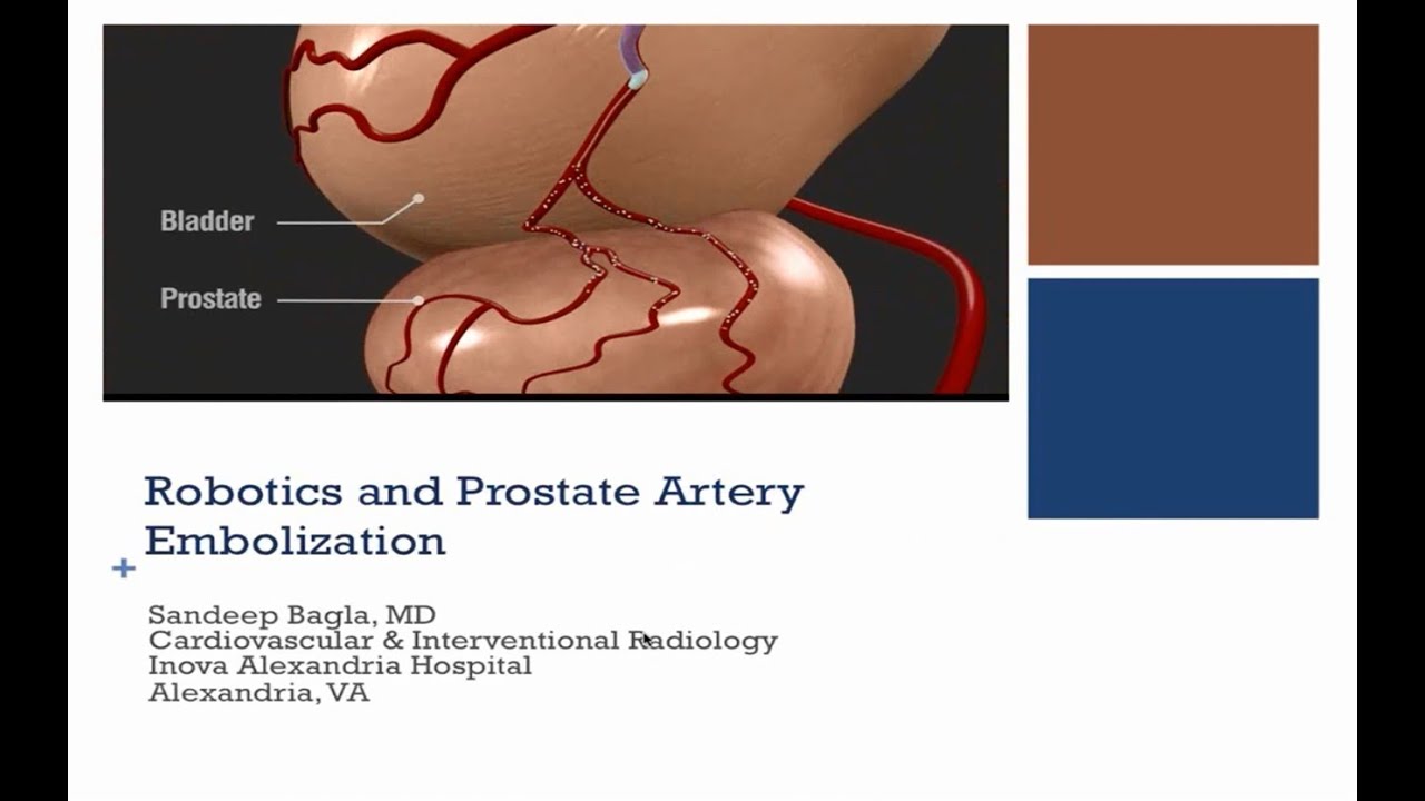 Advantages of Prostate Artery Embolization with the Magellan Robotic System