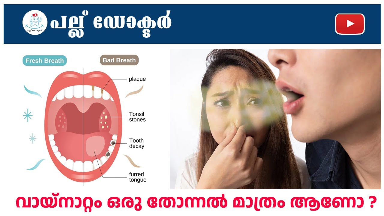 വായ്നാറ്റം ഒരു തോന്നൽ മാത്രം ആണോ ? / 😷 Is Bad Breath Just a Feeling? Or a Real Problem?
