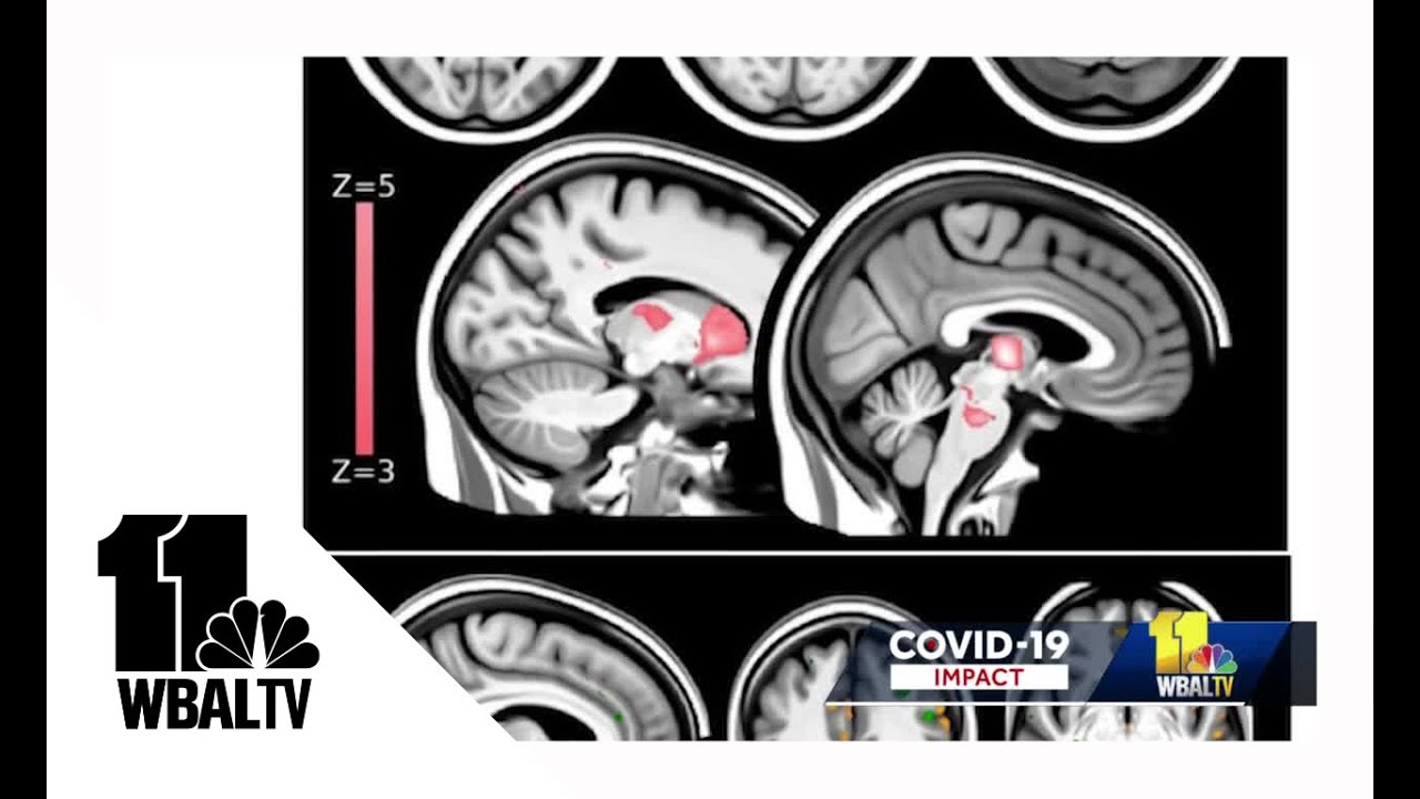 Study: COVID-19 infection causes brain tissue damage