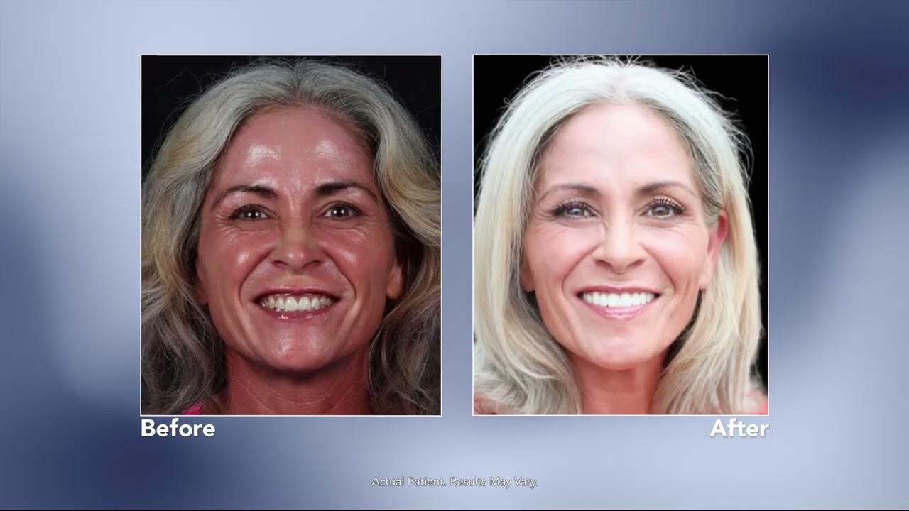 How Dental Implants Can Change Your Life! | with Kerrville, Texas dentist Dr. Huff