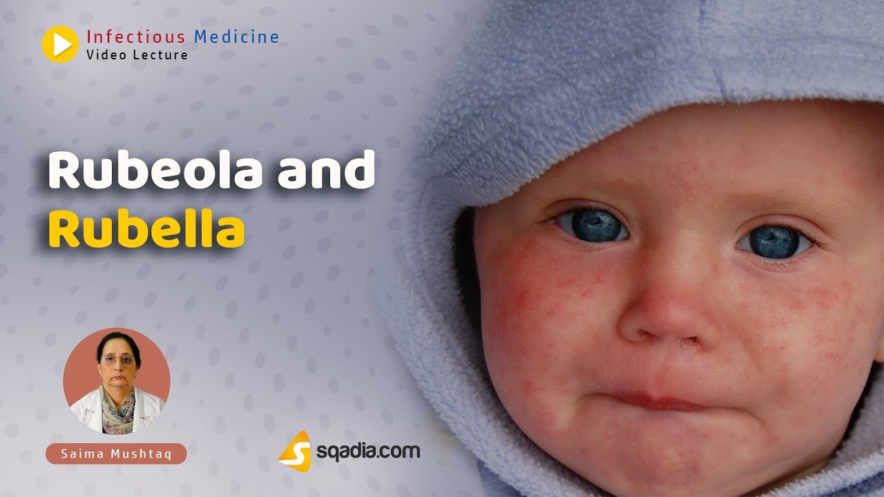 Rubeola and Rubella | Introduction | Infectious Medicine | sqadia.com