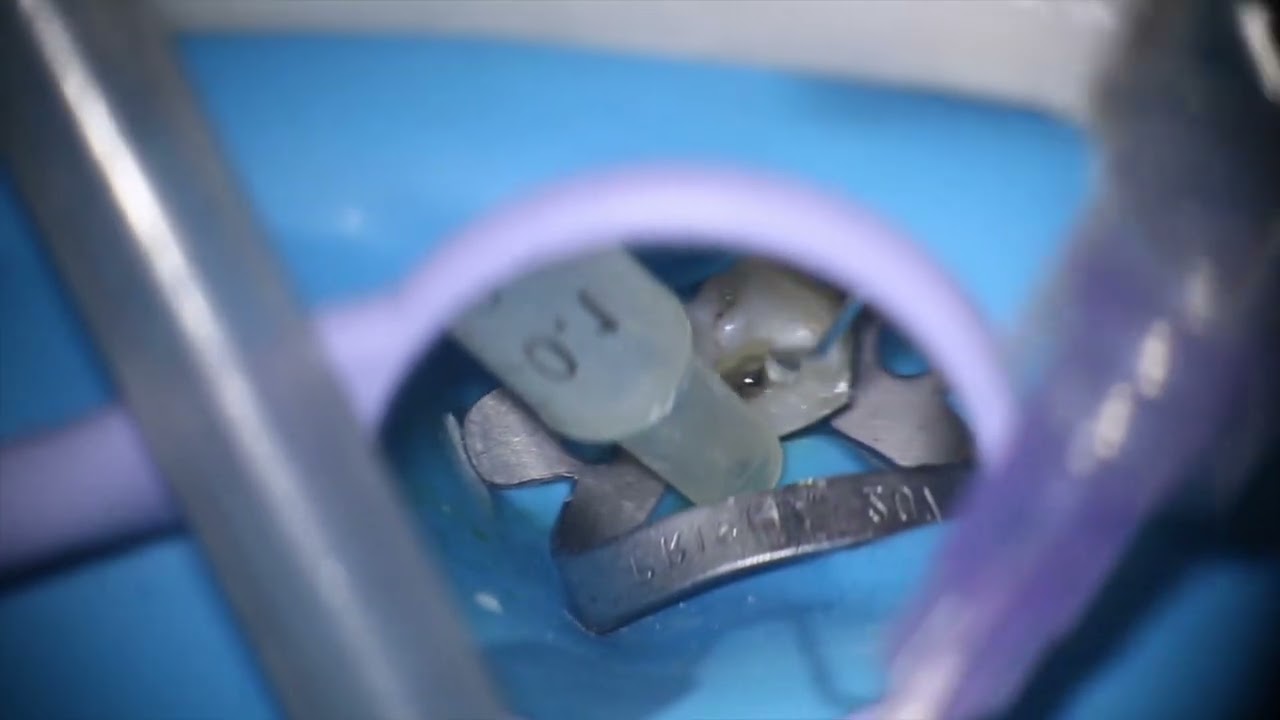 Tratamento Endodôntico com sistema reciprocante + blindagem coronária pós tratamento endodôntico