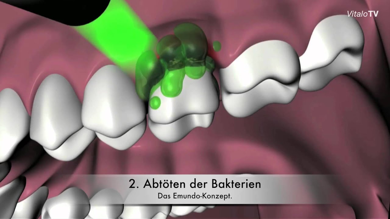 EMUNDO - Konzept. Arc-Laser