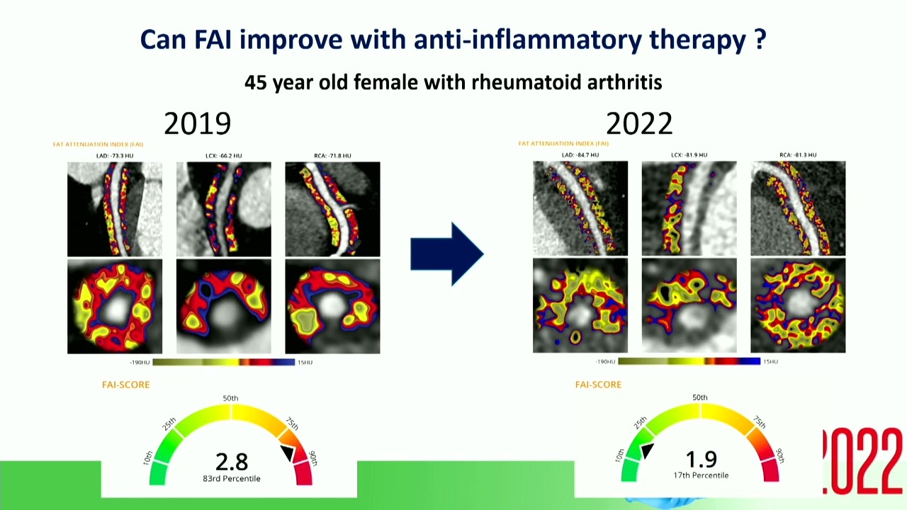 Sponsored Sym | Visualising Coronary Inflammation in CCTA: The Next Frontier for CV Risk Prediction